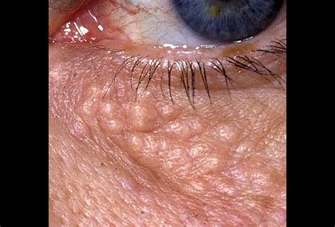 Pictures of Skin Diseases and Problems - Syringoma