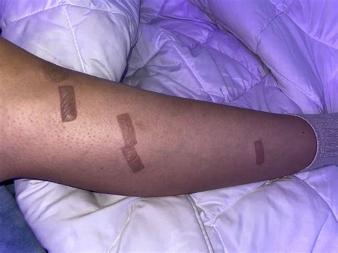 Med Spa Sued by SIL for Causing Laser Injury and Burns During Laser Procedure - Scottsdale ...