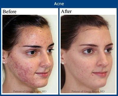 Red Light Therapy Acne Scars Before And After | Americanwarmoms.org