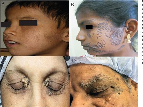 Figure 1 from Bilateral nevus comedonicus of the eyelids: An unusual cause of ptosis and ...