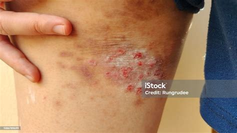 The Rash Hives Itchy Skin Allergy On The Leg Stock Photo - Download Image Now - Leg, Ulcer ...