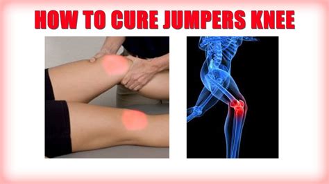 How to cure jumpers knee - YouTube