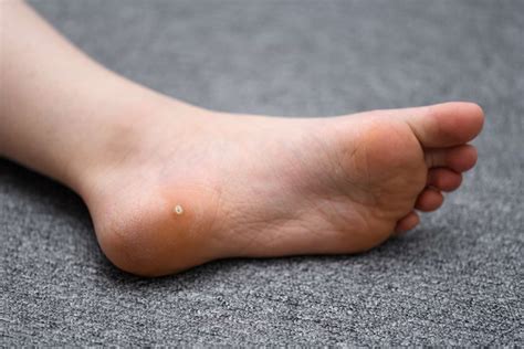 Plantar Warts: Symptoms, Causes, Treatment and More