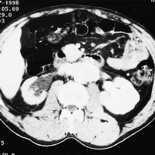 CT scan after ureterolysis followed by long-term steroid | Download Scientific Diagram