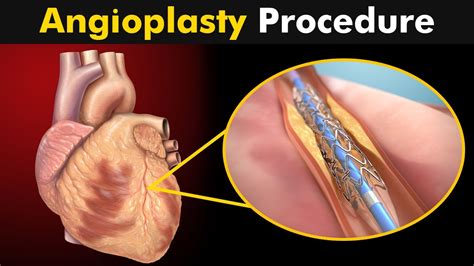 How Angioplasty Procedure is performed? - YouTube