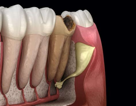 How to treat fistula on the gums | Stomatološka poliklinika Smile