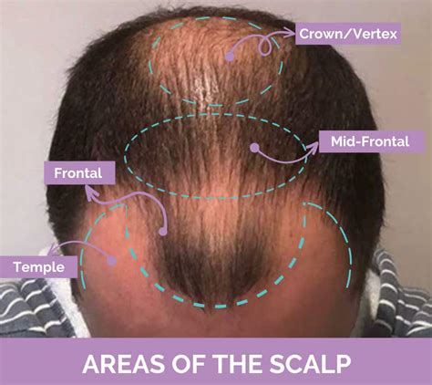 Bald Spot On Crown: Common Causes & Effective Treatments