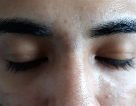 Blackhead scars between Eyebrows – Scar treatments – Acne.org Forum