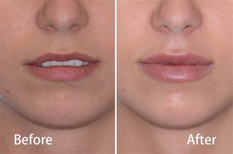 Chin filler before and after - batmanparking