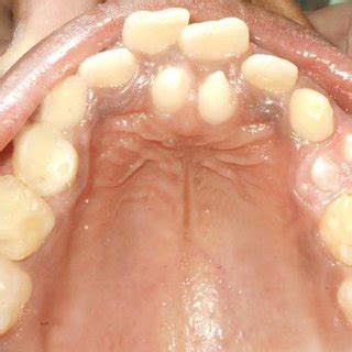 (PDF) PALATALLY ERUPTED TWIN MAXILLARY MESIODENS: A CASE REPORT.