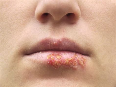 Symptoms Of Herpes Common Herpes Symptoms Youtube