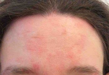 Natural Treatment for Seborrheic Dermatitis - Philadelphia Holistic Clinic