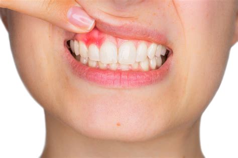The Best And Most Effective Ways To Treat Mouth Sores - Vinnin Square Dental Group