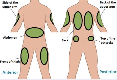 Sites of Subcutaneous Injection And Complications