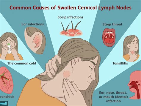 How To Check If Your Lymph Nodes Are Swollen - Birthdaypost10