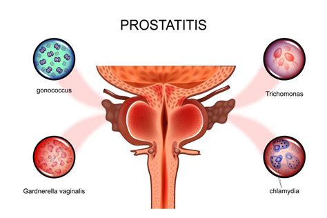 Chronic Epididymitis: Causes, Symptoms, Diagnosis, Treatment | STD.GOV Blog