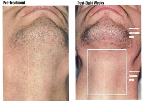 Permanent Hair Removal For Men - Hair Removal