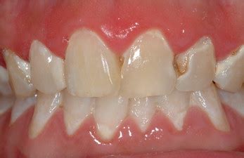 White spot lesions: Prevention and treatment | Pocket Dentistry