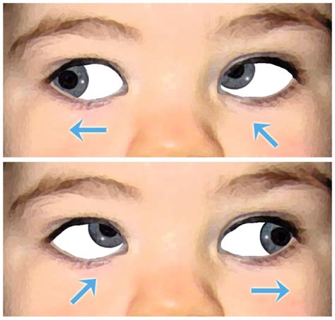 Hyperfunction of the inferior oblique muscle - Athens Eye Hospital