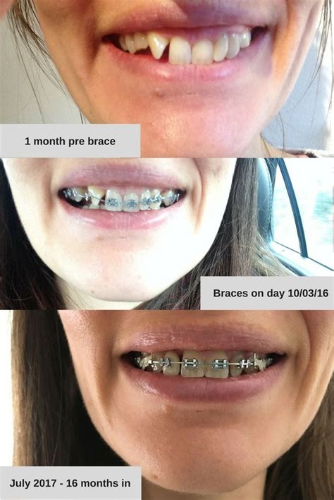 Gap Teeth Before And After Braces