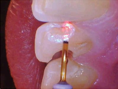 What is Beyond the Dental Drill? - Oral Health Group