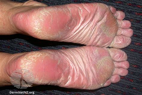 Psoriatic Arthritis Toes