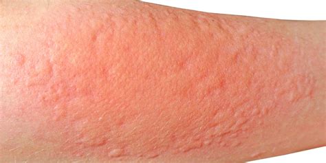 Contact Dermatitis Treatments | SLO | Coastal Dermatology