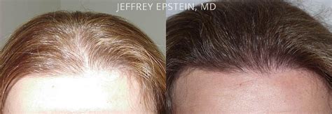 Hair Transplants for Women fotos | Miami, FL | Paciente 41566