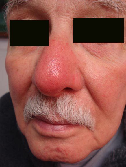 Nasal Vestibulitis - Nasal vestibulitis causes, symptoms, complications ...