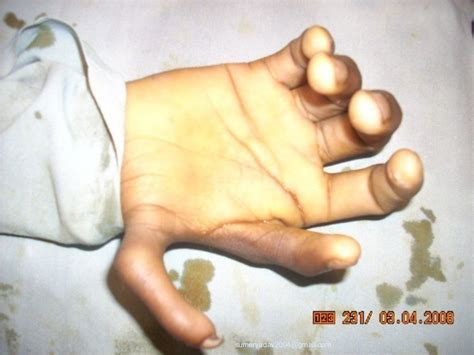 common congenital deformities of hand