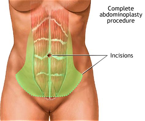 Abdominoplasty Surgery - Recovery, Before and After, Risks