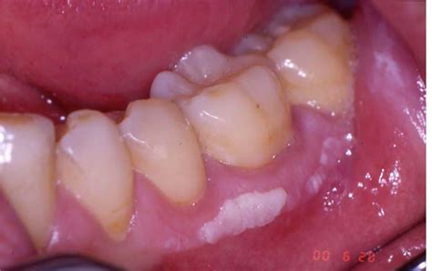 Leukoplakia – European Association of Oral Medicine