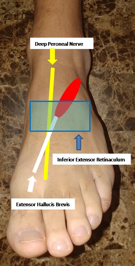 Anterior Tarsal Tunnel Syndrome