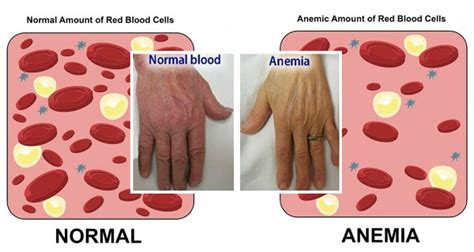 Anemia - Masalah Kekurangan Darah Merah - Tips Kesihatan