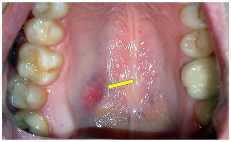 Mouth Cancer Bumps Under Tongue