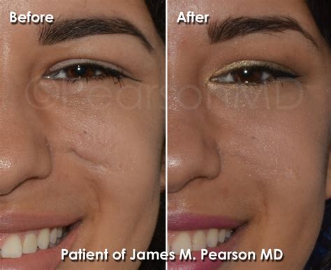 Scar Revision Photos - Before & After - Dr. James Pearson Facial ...