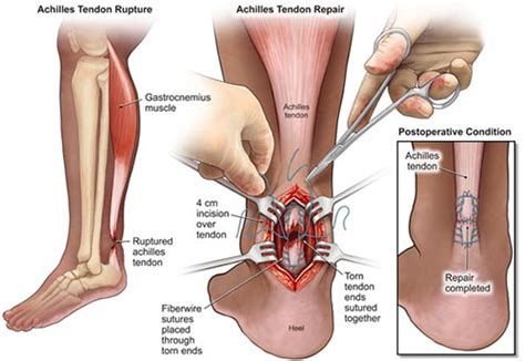 Achilles Tendon Tear