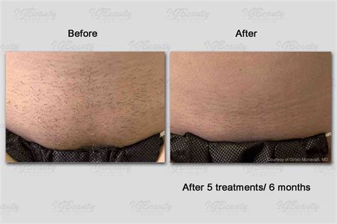 Laser Hair Removal Toronto | IGBeauty Laser Clinic