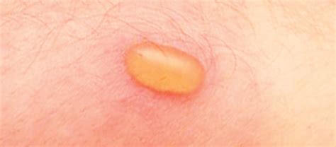 Blister Beetle Bites: Identification of Blister Beetle Warts