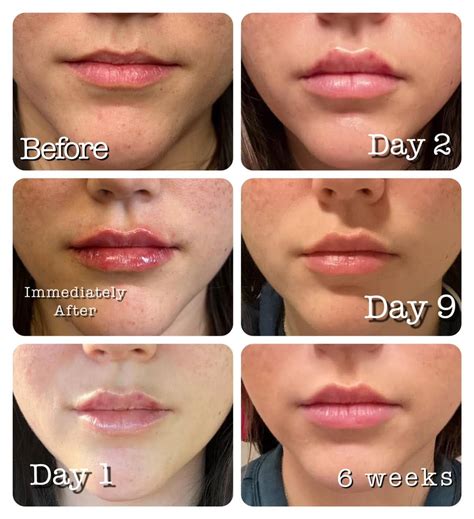 Lip Filler Swelling Stages | Central Texas Dermatology