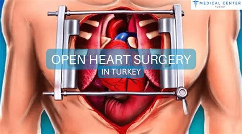 Open Heart Surgery in Turkey - MCT