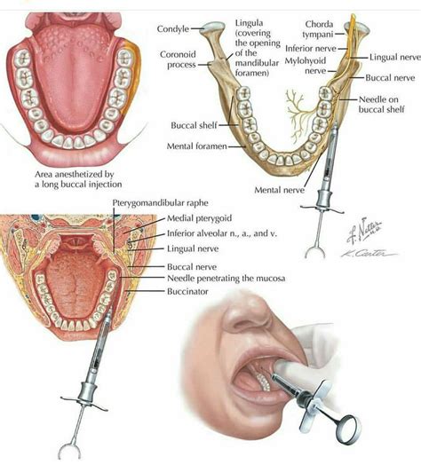 Correct long buccal nerve block technique - MEDizzy