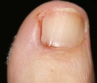 Partial nail avulsion and phenolisation - Health Plus Chiropractic