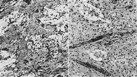 Juvenile pilocytic astrocytoma of the cerebrum in adults in: Journal of ...