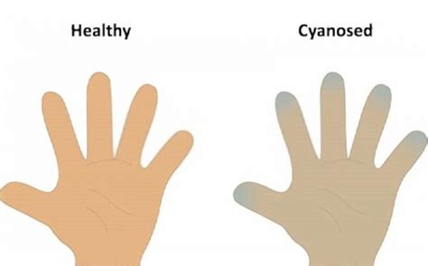 Blue Baby Syndrome: Causes, Symptoms, Diagnosis and Treatments