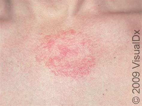 Seborrheic Dermatitis: On Scalp, Treatment, Crib Cap, And, 50% OFF