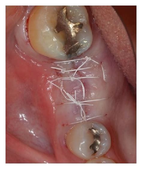 Guided bone regeneration procedure was performed on the erratic ...