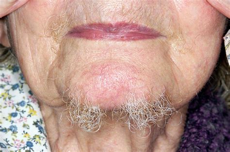 Hair Growth On The Chin Of A Woman Photograph by Dr P. Marazzi/science ...