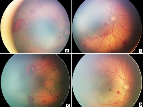 Retinal Hemorrhage Diagram