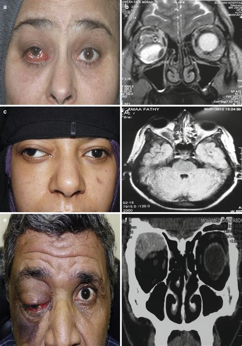 Retrobulbar Hemorrhage: Etiology, Pathogenesis, Epidemiology, and Clinical Perspectives | Ento Key